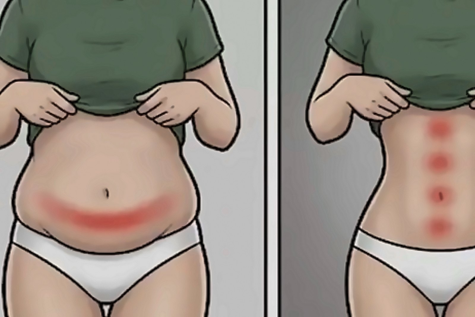 Ilustración de un abdomen antes y después de reducir grasa